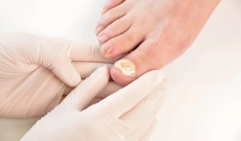 Ontstoken Nagelriem Behandelen: Effectieve Remedies en Tips
